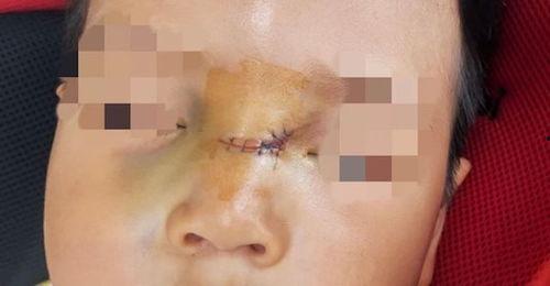 脸部缝针后吃矮瓜行吗,矮瓜食用指南