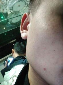 杰西吃瓜过敏